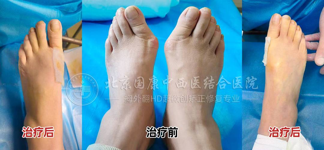 北京国康医院治疗痛风