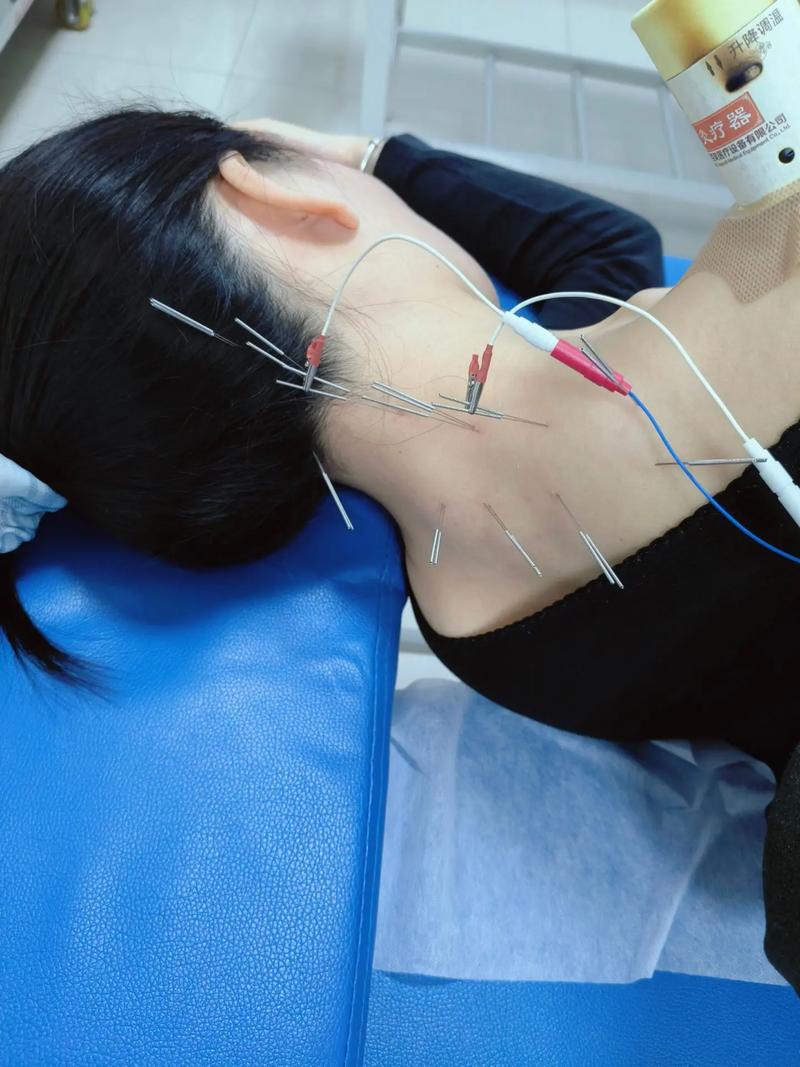 北京军区总医院 针灸