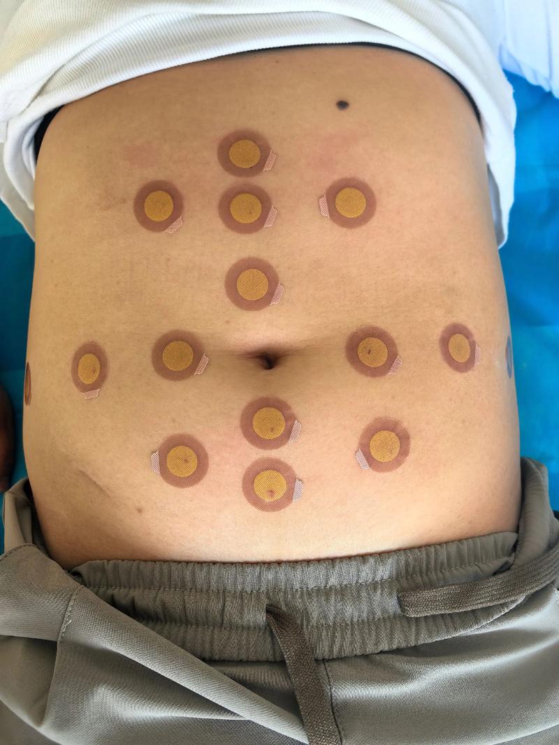 深圳中医院 针灸减肥