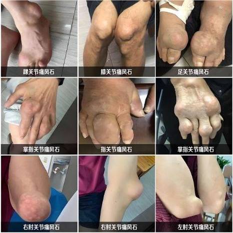 什么病和痛风症状相似