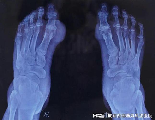 痛风脚关节为什么黑色