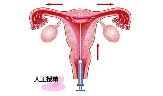 那家医院人工受精安全