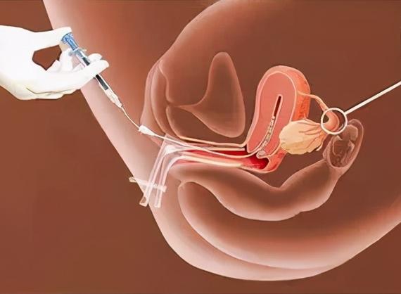 人工受精医院哪家安全