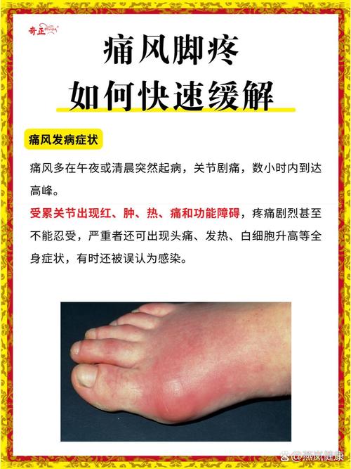 尿酸高痛风多久能治好