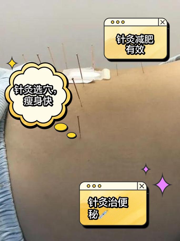 第九人民医院针灸减肥