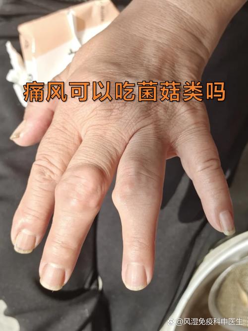 痛风患者可以吃蘑菇吗