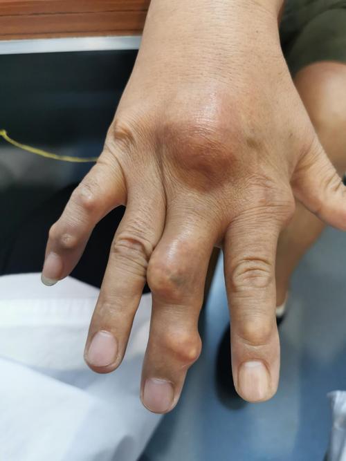 痛风石出现有什么表现