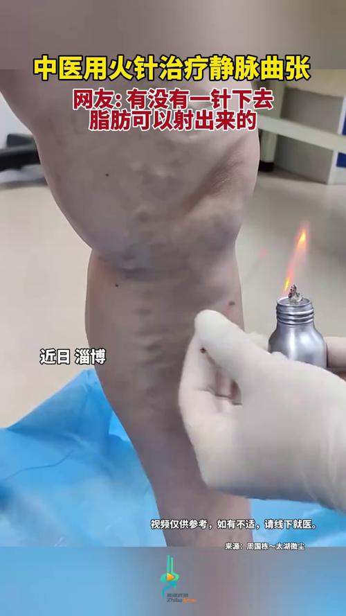 针灸可以治疗静脉曲张