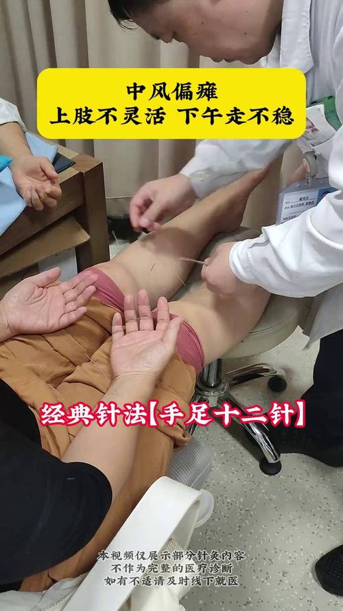 针灸对中风的治疗方法