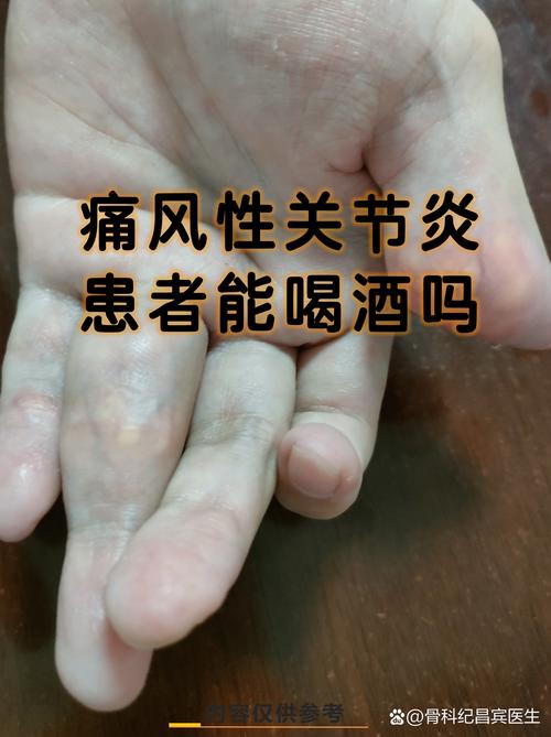 痛风患者可以喝啤酒吗