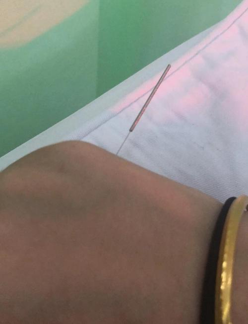 医院针灸是一次性的吗