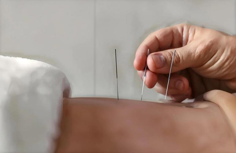 神经官能症的针灸治疗