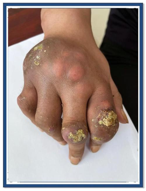 痛风石什么症状有哪些