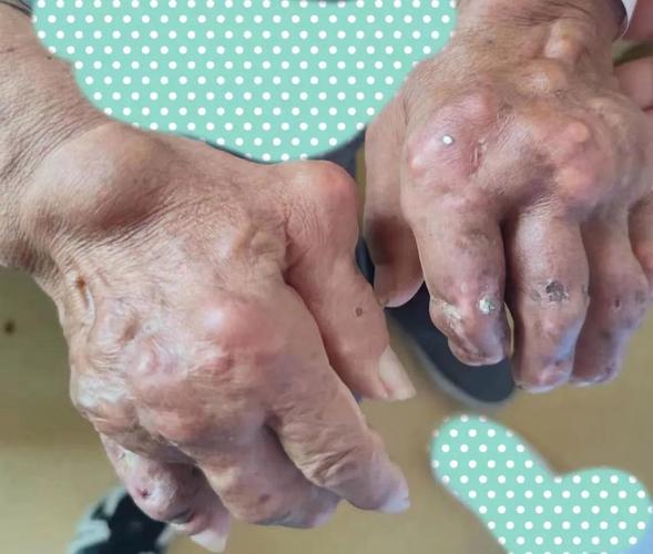 痛风石什么症状有哪些