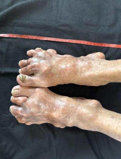 痛风石什么症状有哪些