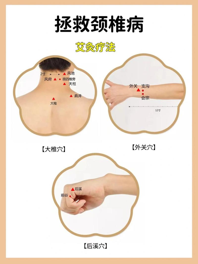 颈椎病的针灸治疗穴位