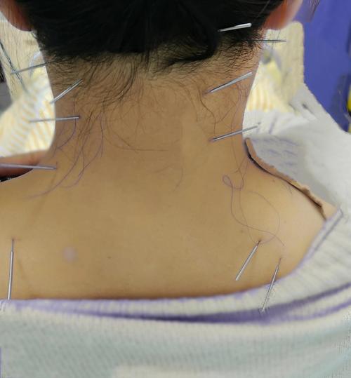 颈椎病的针灸治疗穴位