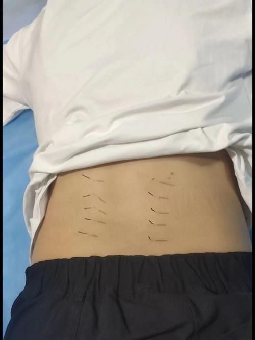 腰椎间盘突出症与针灸