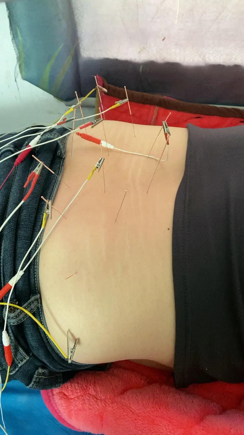 腰椎间盘突出症与针灸