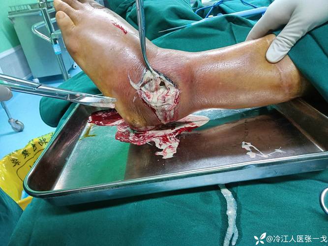 苗老师治疗痛风可靠吗