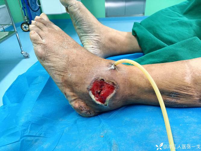 苗老师治疗痛风可靠吗