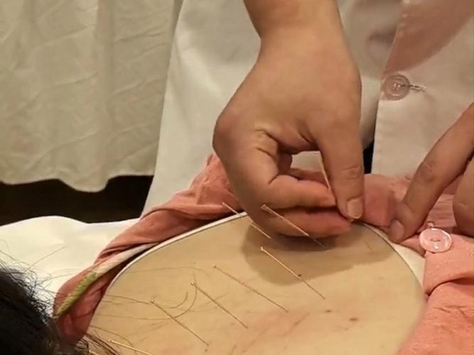 子宫下垂的的针灸治疗