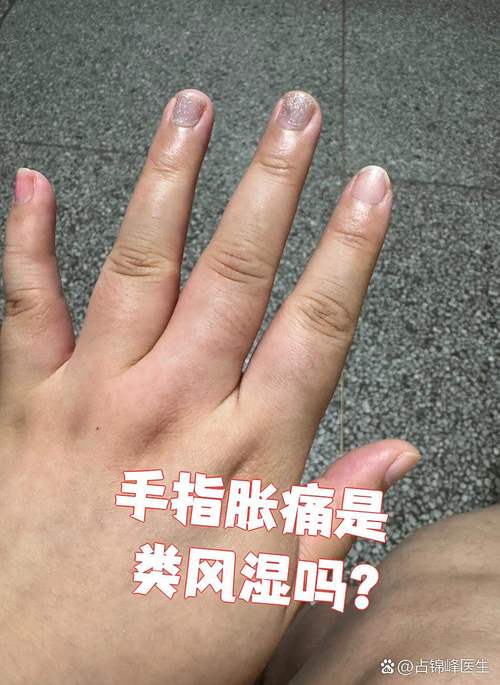 手指肿痛发热是痛风吗