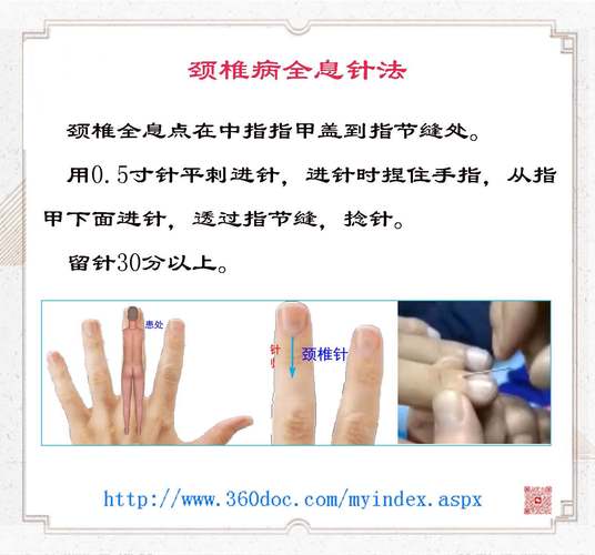 颈椎病的针灸治疗方法