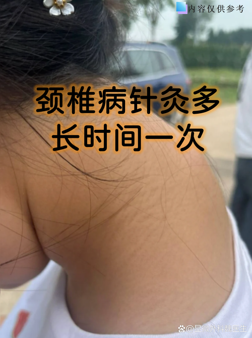 颈椎病的针灸治疗方法