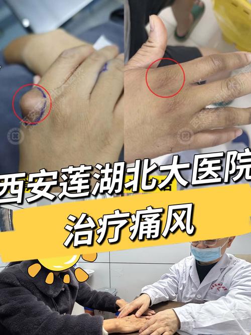 北京哪个医院看痛风好