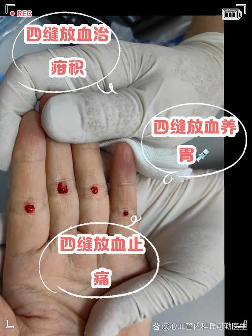 痛风放血疗法往哪里扎