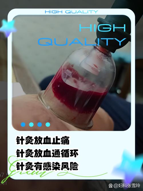 痛风放血疗法往哪里扎