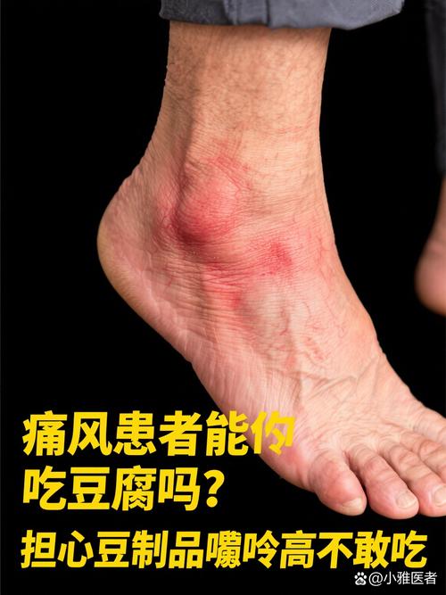 痛风可以吃日本豆腐吗