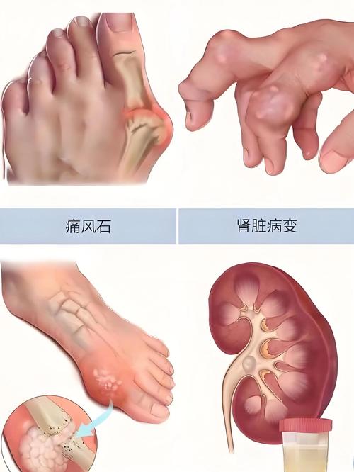 尿酸高跟痛风有关系吗