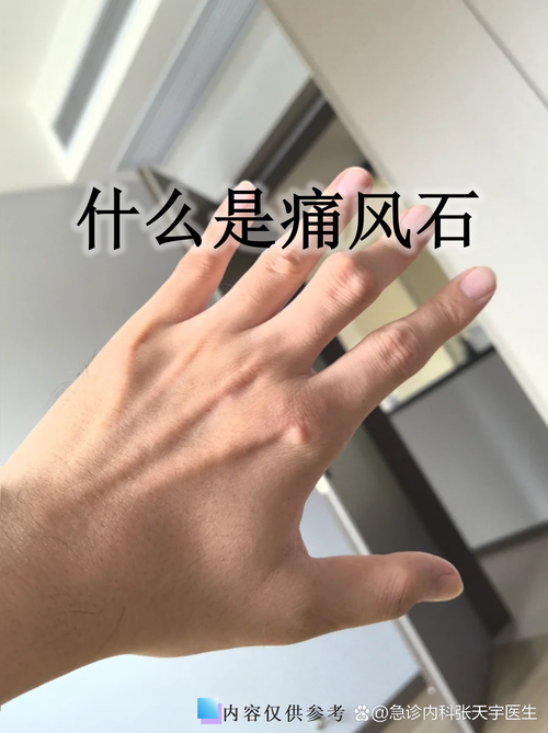 尿酸高跟痛风有关系吗