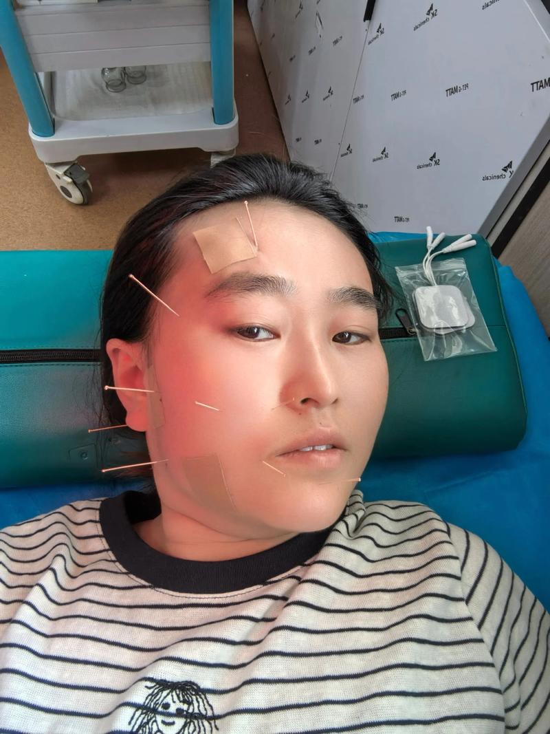 面瘫能直接挂针灸科吗