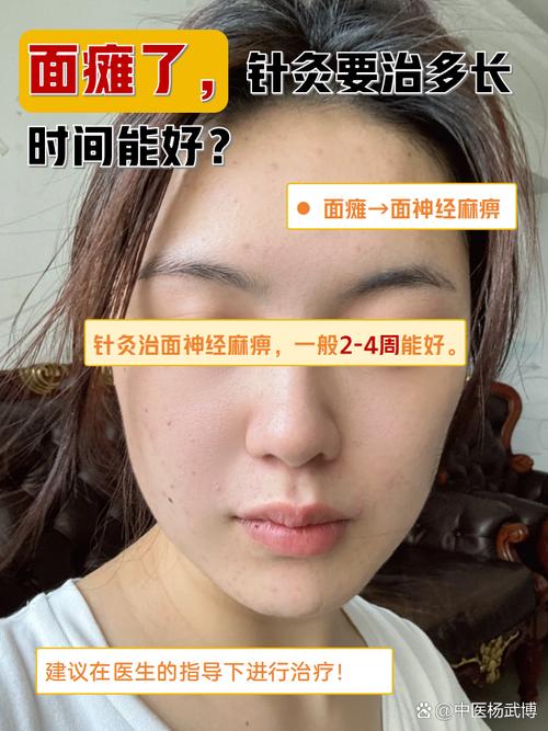 针灸可以治脸不对称吗