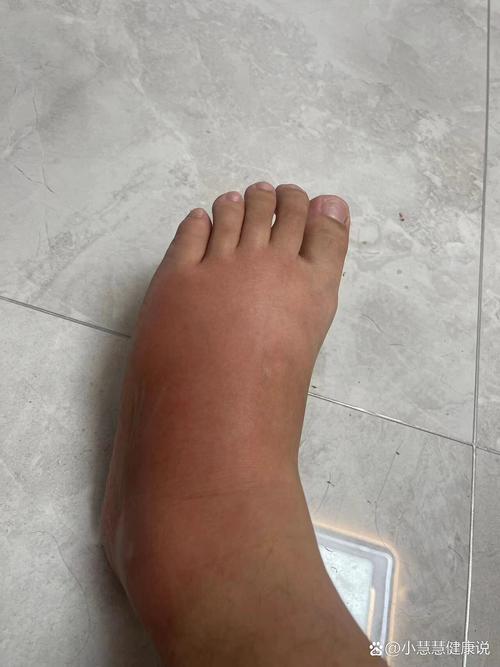 老公痛风生女孩几率大