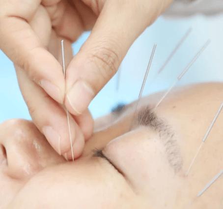 江苏省中医院眼部针灸