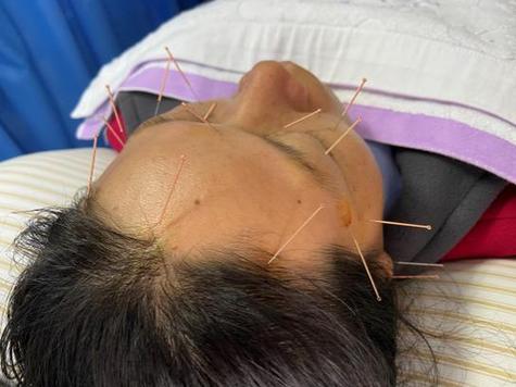 江苏省中医院眼部针灸