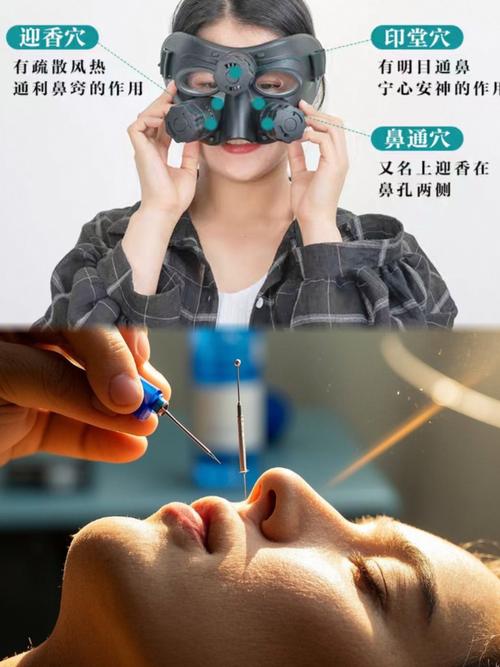 浙江省中医院针灸鼻炎