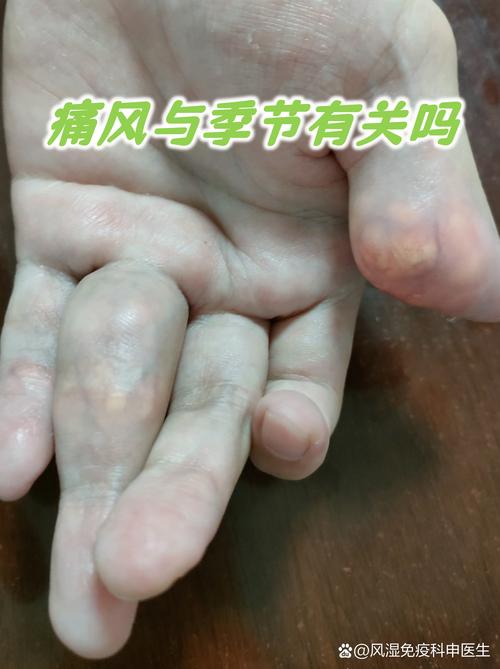 痛风是不是体内有湿气