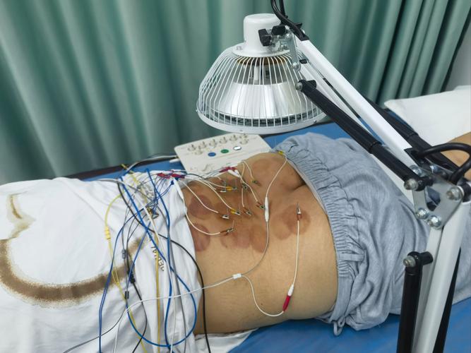 腰椎针灸间隔多久一次