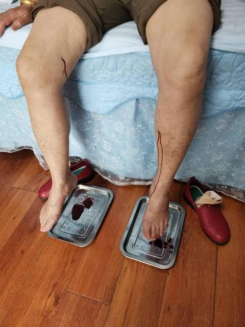 痛风中医放血疗法视频