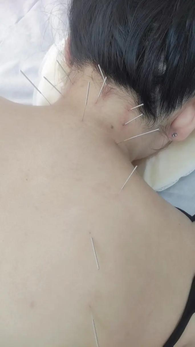 来例假可以针灸肩颈吗