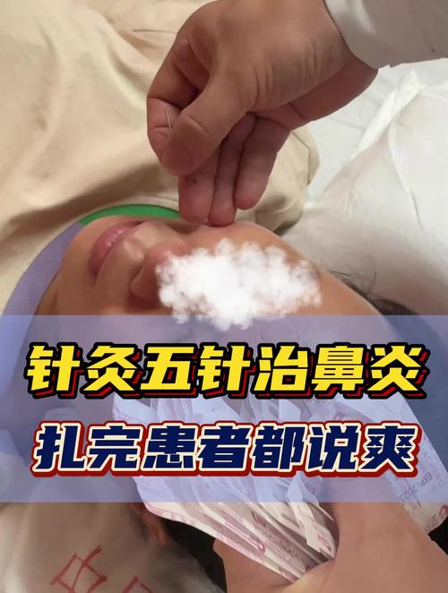 针灸可以治疗鼻窦炎么