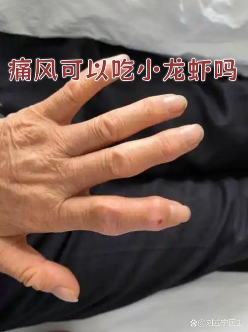 痛风为什么不能吃龙虾