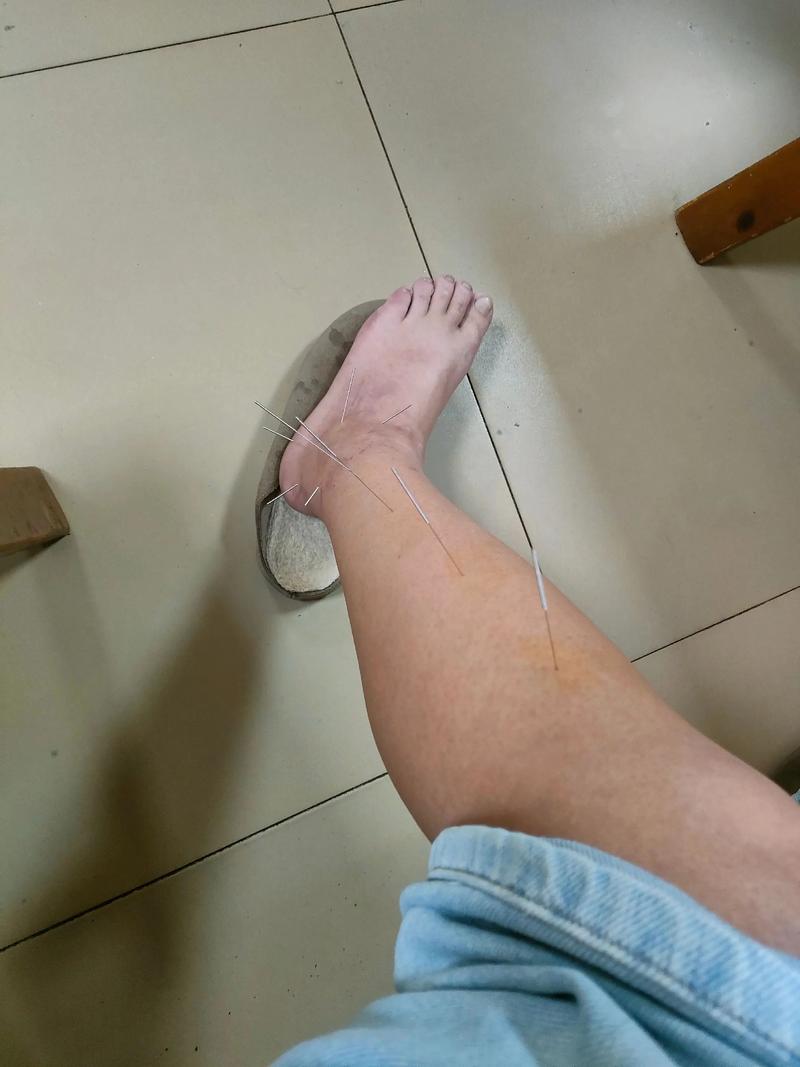 脚韧带拉伤针灸有用吗