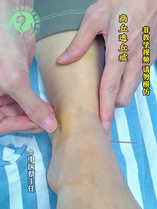 脚韧带拉伤针灸有用吗