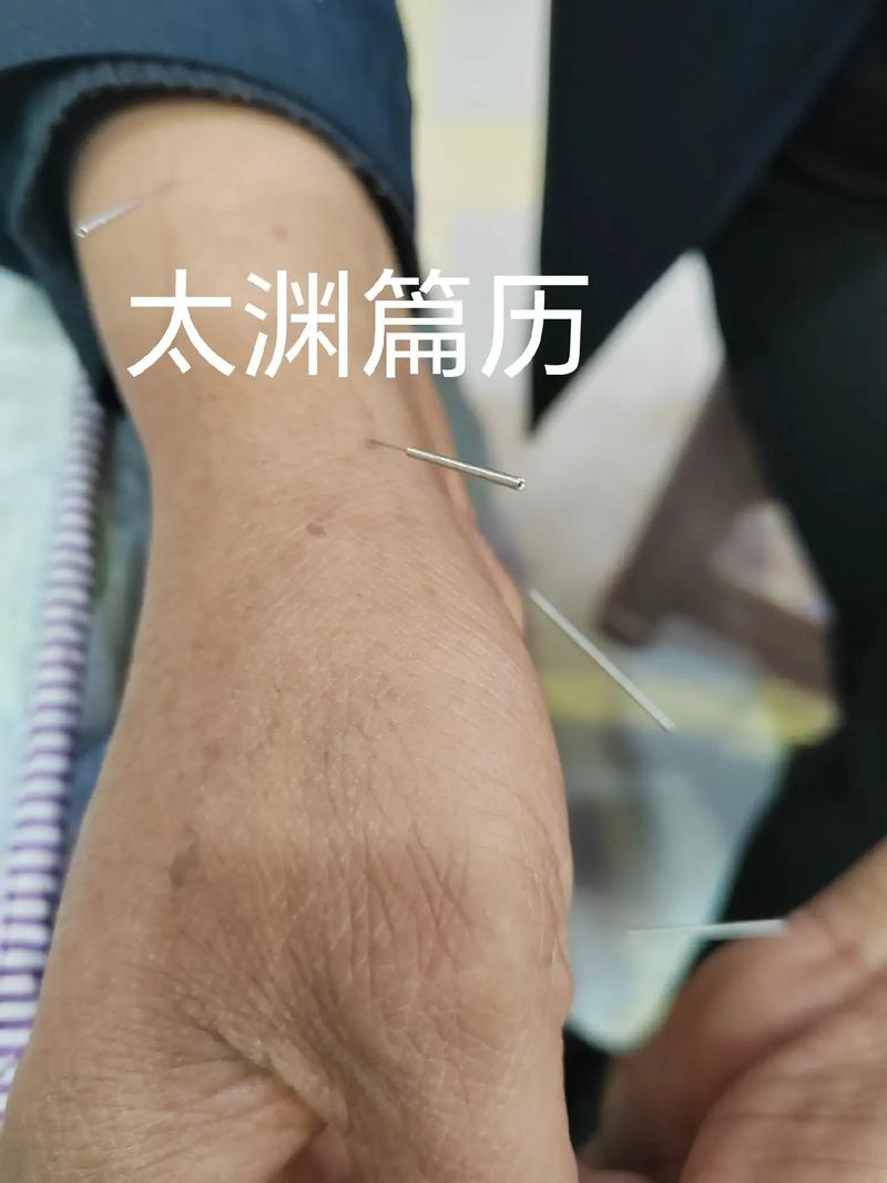 过敏性咳嗽可以针灸吗